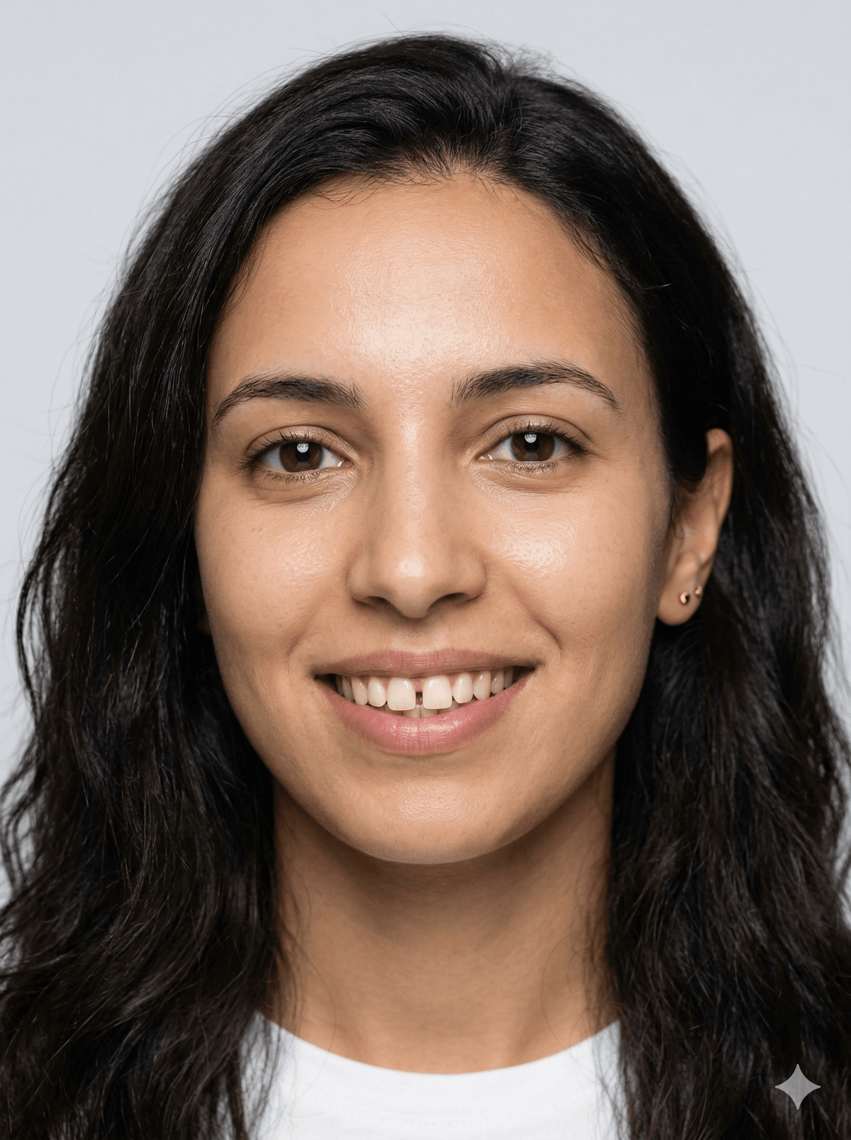 Dents avant la pose de facettes céramique, Clinique LaBeldent Mohammedia