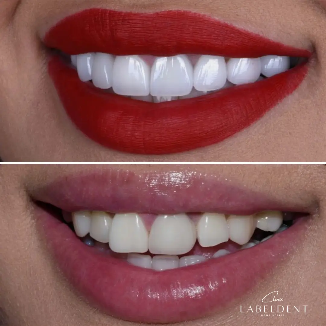 Facettes céramique homme smile design avant après, Clinique LaBeldent Mohammedia