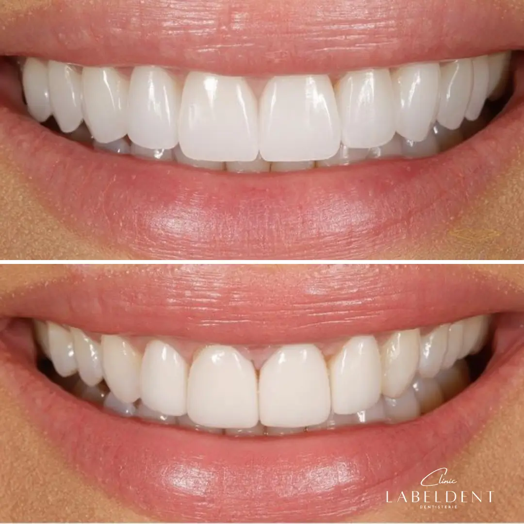 Facettes Hollywood Smile avant après, Clinique LaBeldent Mohammedia