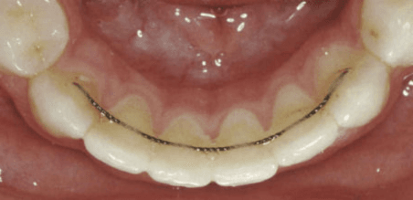 Appareil de contention orthodontique pour maintenir les dents après traitement