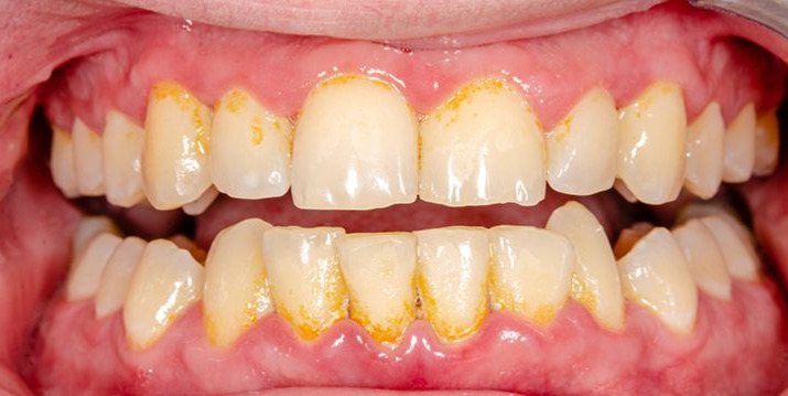 Accumulation de tartre dentaire sur les dents avant un détartrage professionnel à la Clinique LaBeldent Mohammedia