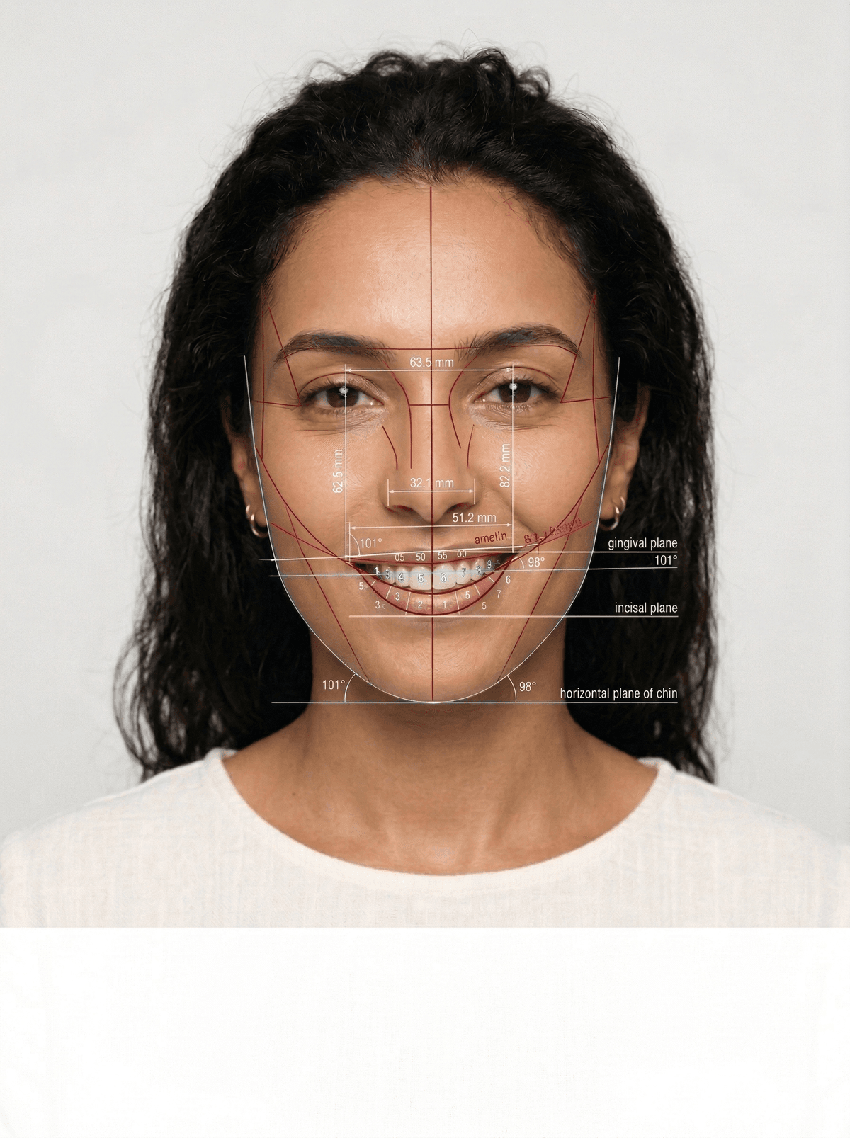 Bilan numérique Digital Smile Design avant pose de facettes, Clinique LaBeldent Mohammedia