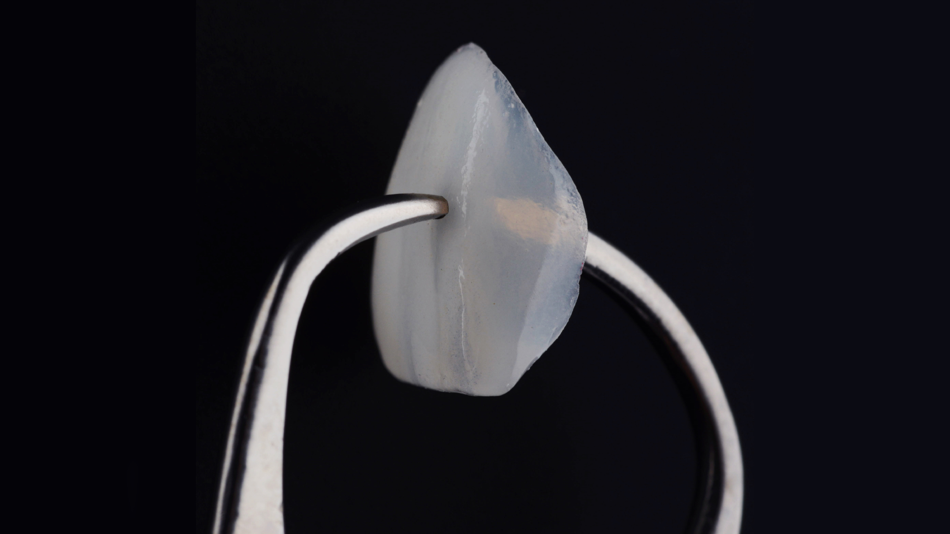 Gros plan sur une facette dentaire en céramique de haute précision - Clinique LaBeldent