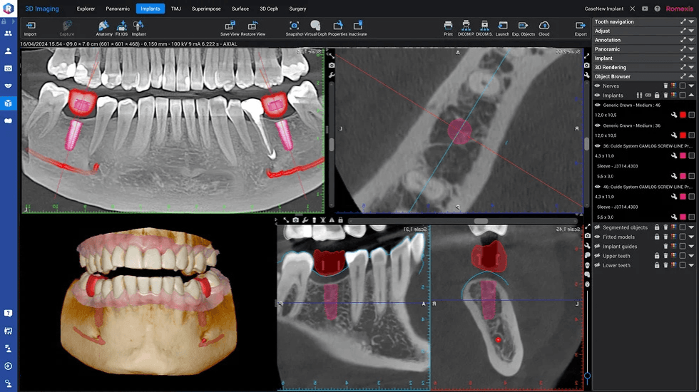 Planification 3D implant dentaire sur scanner CBCT, Clinique LaBeldent Mohammedia