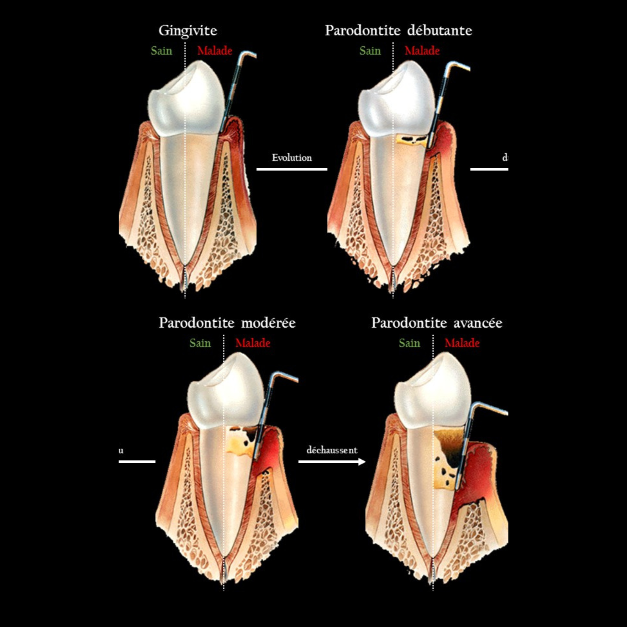 Surfaçage radiculaire pour éliminer le tartre sous-gingival et traiter la parodontite, Clinique LaBeldent Mohammedia